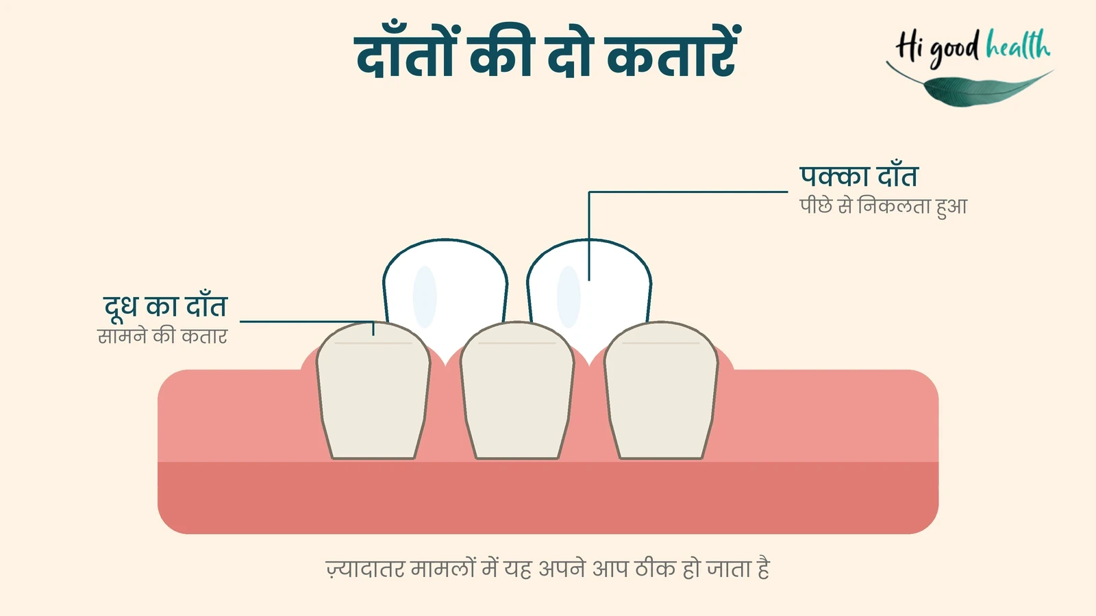 दूध के दाँत के पीछे से निकलता पक्का दाँत, दाँतों की दो कतारें बनाता हुआ