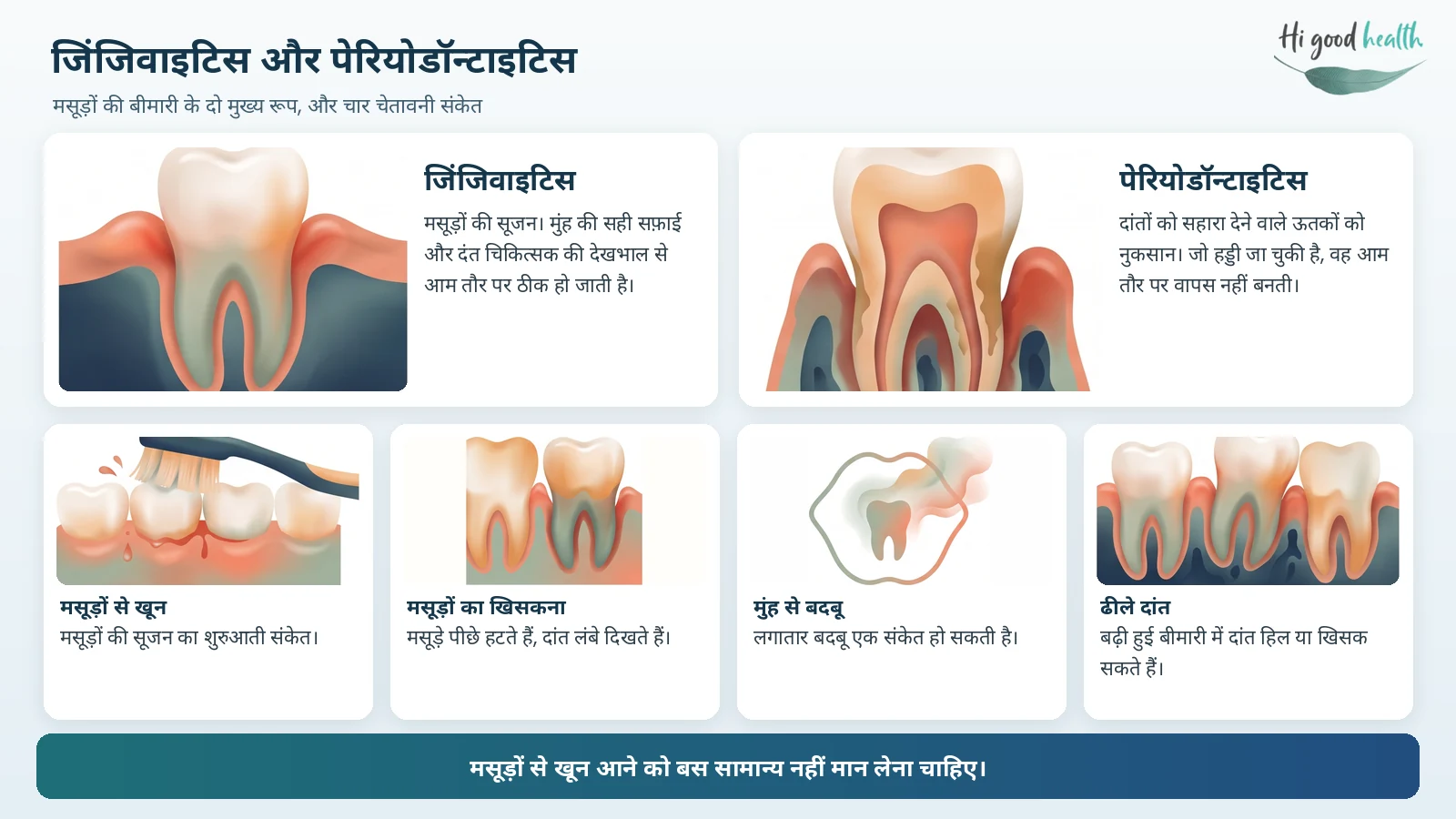 पायरिया (मसूड़ों की बीमारी) का इलाज: कारण, लक्षण, उपचार और बचाव 3 जिंजिवाइटिस और पेरियोडॉन्टाइटिस: मसूड़ों की सूजन जो आम तौर पर ठीक हो जाती है, और दांतों को सहारा देने वाले ऊतकों व हड्डी का नुकसान, साथ में चार चेतावनी संकेत: मसूड़ों से खून, मसूड़ों का खिसकना, मुंह से बदबू और ढीले दांत