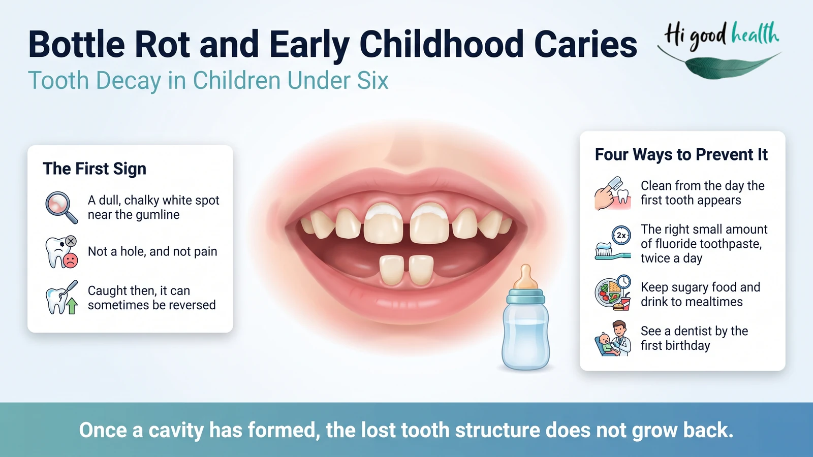 Infographic on early childhood caries: a toddler's front baby teeth showing a chalky white band at the gumline, the first sign, and four ways to prevent it