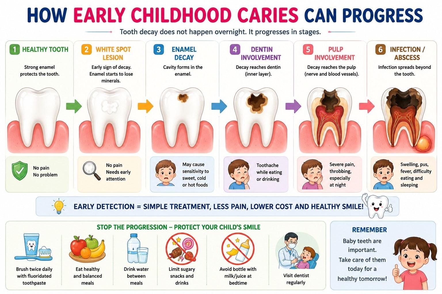 Infographic: how early childhood caries progresses in six stages &mdash; healthy tooth, white spot lesion, enamel decay, dentin involvement, pulp involvement and infection or abscess &mdash; with the symptoms and treatment implications at each stage.
