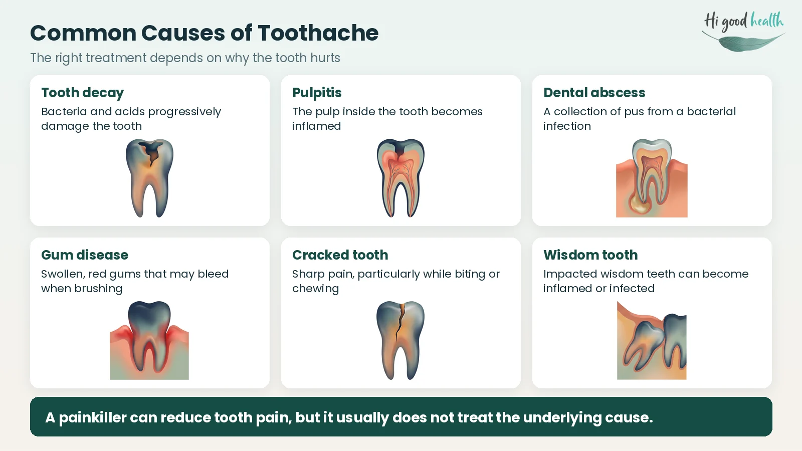 Medicine for Toothache: What to Take, Causes, Treatment and FAQs 3 Infographic of six common causes of toothache: tooth decay, pulpitis, dental abscess, gum disease, a cracked tooth and an impacted wisdom tooth, each shown on a single tooth