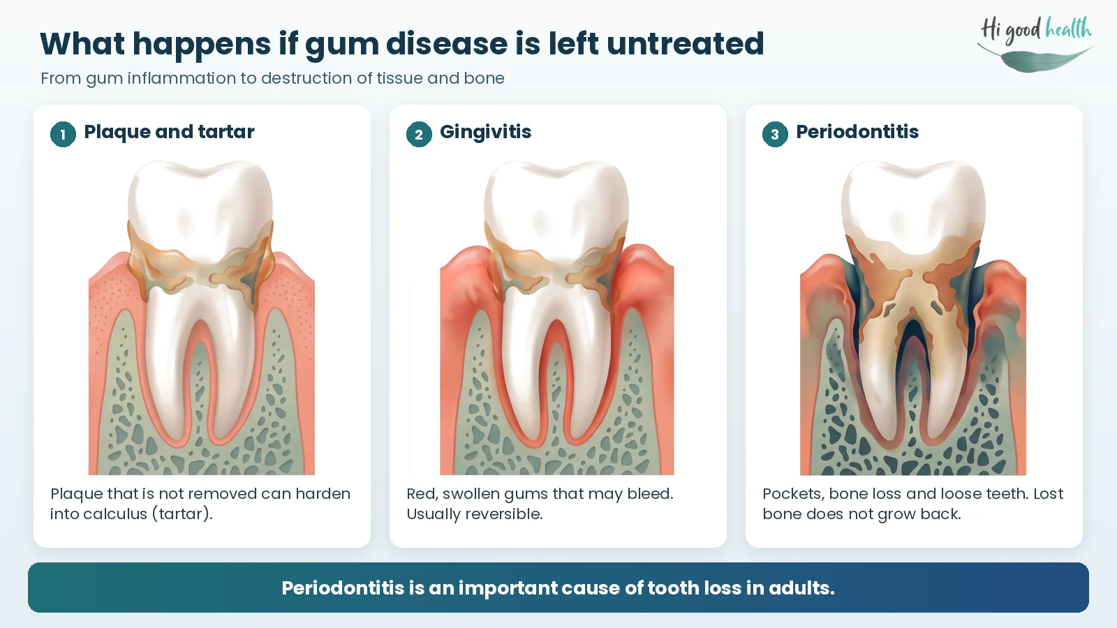 Pyorrhea (Gum Disease): Causes, Symptoms, Treatment and Prevention 5 How untreated gum disease progresses: plaque and tartar at the gumline, then gingivitis with red swollen gums, then periodontitis with pockets, bone loss and loose teeth
