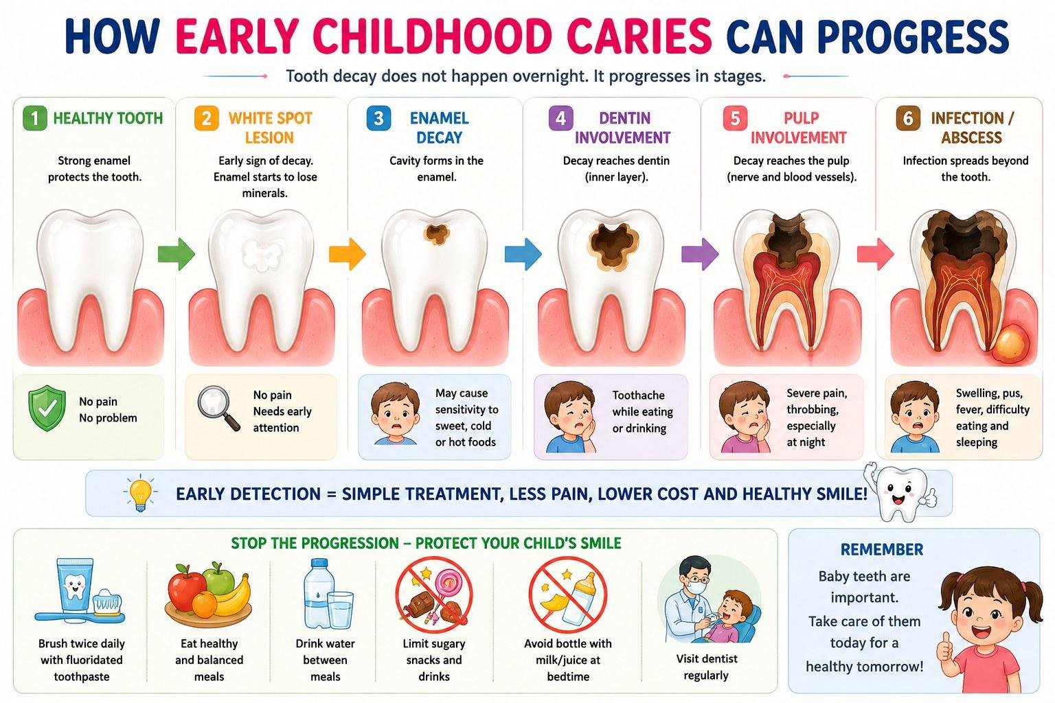 Infographic: how early childhood caries progresses in six stages &mdash; healthy tooth, white spot lesion, enamel decay, dentin involvement, pulp involvement and infection or abscess &mdash; with the symptoms and treatment implications at each stage.