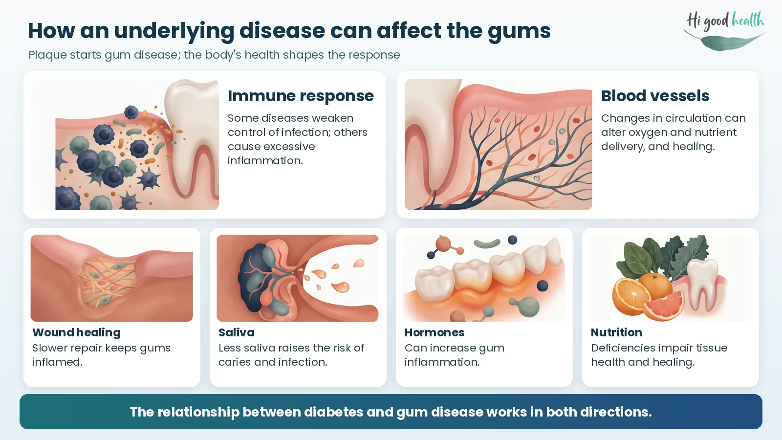 How an underlying disease can affect the gums: through the immune response, blood vessels, wound healing, saliva, hormones and nutrition
