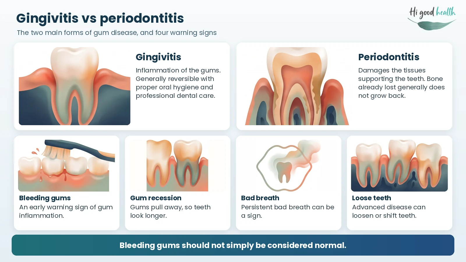 Gingivitis versus periodontitis: gum inflammation that is generally reversible, and damage to the tissues and bone supporting the teeth, with four warning signs: bleeding gums, gum recession, bad breath and loose teeth